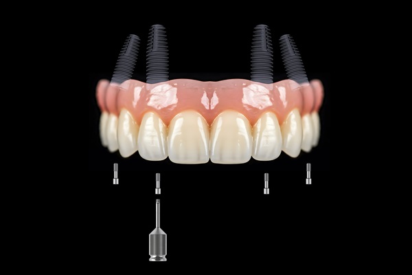 Things To Know About Implant Supported Dentures